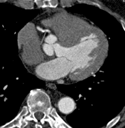 Plaque in RCA - CTisus CT Scan