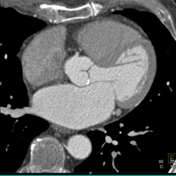 Calcified Aortic Valve - CTisus CT Scan