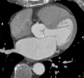 Diseased LAD With Stenosis in Multiple Perspectives and Renderings - CTisus CT Scan