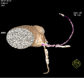 Plaque in Circumflex Coronary Artery - CTisus CT Scan