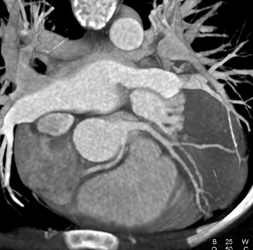 VRT Shows Aberrant Origin as Compared to MIP - CTisus CT Scan