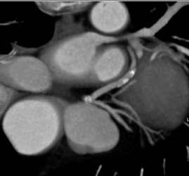 Diseased LAD - CTisus CT Scan