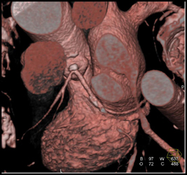 Diseased LAD - CTisus CT Scan