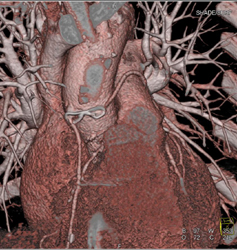 Bypass Grafts - CTisus CT Scan