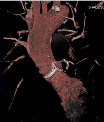 Aortic Valve-see 4d Also - CTisus CT Scan