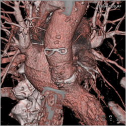 Bypass Grafts - CTisus CT Scan