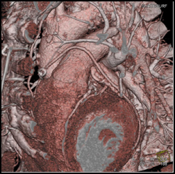 Bypass Grafts - CTisus CT Scan