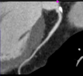 Disease in Left Main Coronary Artery - CTisus CT Scan