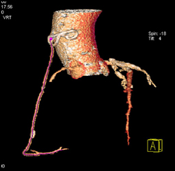 Bypass Graft With Patency - CTisus CT Scan