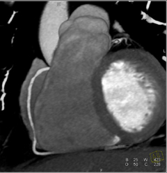 Minimal Stenosis in Proximal RCA - CTisus CT Scan