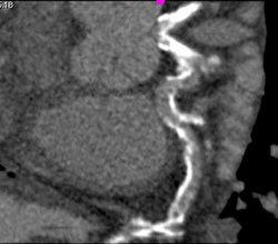 Extensive Disease in the Circumflex Coronary Artery - CTisus CT Scan