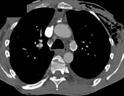 Ductus Artery Aneurysm - CTisus CT Scan