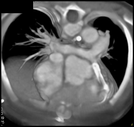 Stent in Left Pulmonary Artery - CTisus CT Scan