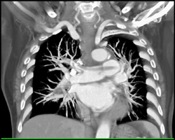 Pulmonary Embolism - CTisus CT Scan