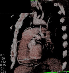 Bypass Graft and Aortic Dissection - CTisus CT Scan