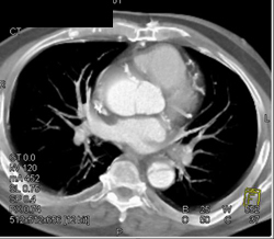 Type A Dissection - CTisus CT Scan