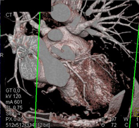 Normal Left Main Coronary Artery and Bifurcation of LAD and Circumflex Artery (CX) - CTisus CT Scan