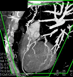 Left Internal Mammary Artery (LIMA) Bypass Graft - CTisus CT Scan