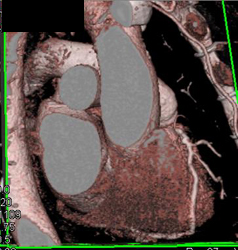 Diseased RCA - CTisus CT Scan