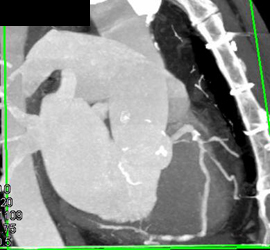 Diseased RCA - CTisus CT Scan