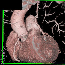 Diseased RCA Plus Left Internal Mammary Artery (LIMA) Bypass - CTisus CT Scan