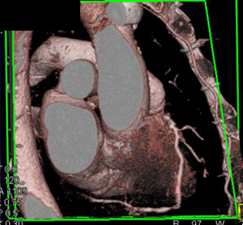 Diseased RCA - CTisus CT Scan