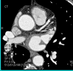 Soft Plaque in the LAD - CTisus CT Scan