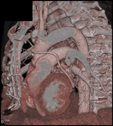 Bypass Graft - CTisus CT Scan