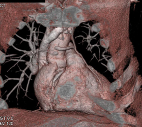 Occluded Saphenous Graft - CTisus CT Scan