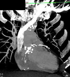 Diseased Coronary Arteries With Extensive Calcified Plaque - CTisus CT Scan