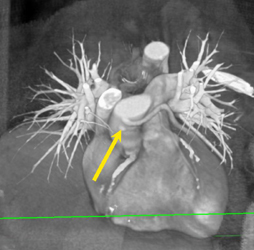 Occluded Bypass Graft - CTisus CT Scan