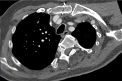 Dissection in Subclavian Artery - CTisus CT Scan