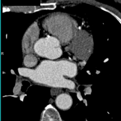 Multivessel Disease With Calcified Plaque - CTisus CT Scan