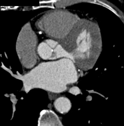 Calcified Aortic Valve - CTisus CT Scan