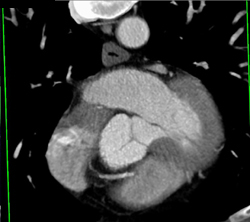 Normal Aortic Valve - CTisus CT Scan