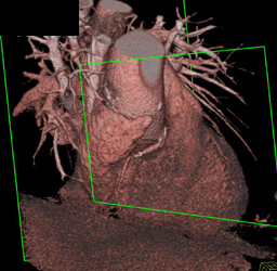 Diseased RCA - CTisus CT Scan