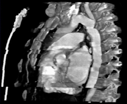 Patient Breathing Through A Gated Study - CTisus CT Scan