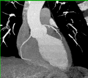 Normal Coronary Arteries - CTisus CT Scan