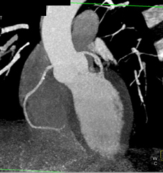 Normal Coronary Arteries - CTisus CT Scan