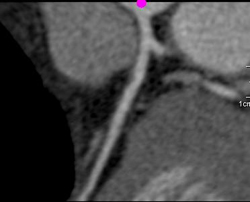 Diseased Circumflex Coronary Artery - CTisus CT Scan