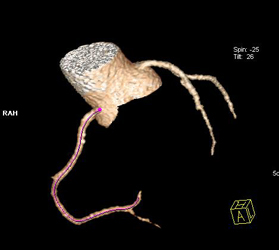 Normal RCA - CTisus CT Scan