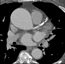 Motion Artifact Creates Two Coronary Arteries - Cardiac Case Studies ...