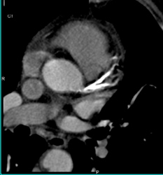 Diseased LAD and Circumflex Artery (CX) Coronary Arteries - CTisus CT Scan