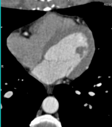 Plaque in RCA - CTisus CT Scan