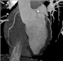 Plaque in RCA - CTisus CT Scan