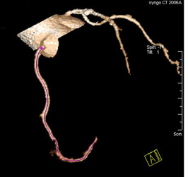 Plaque in RCA - CTisus CT Scan