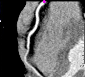 Myocardial Bridging - CTisus CT Scan