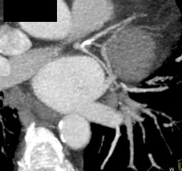 Diseased LAD - CTisus CT Scan