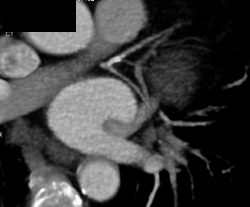 Diseased LAD - CTisus CT Scan