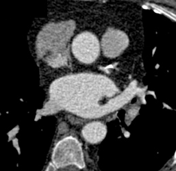 Diseased LAD - CTisus CT Scan